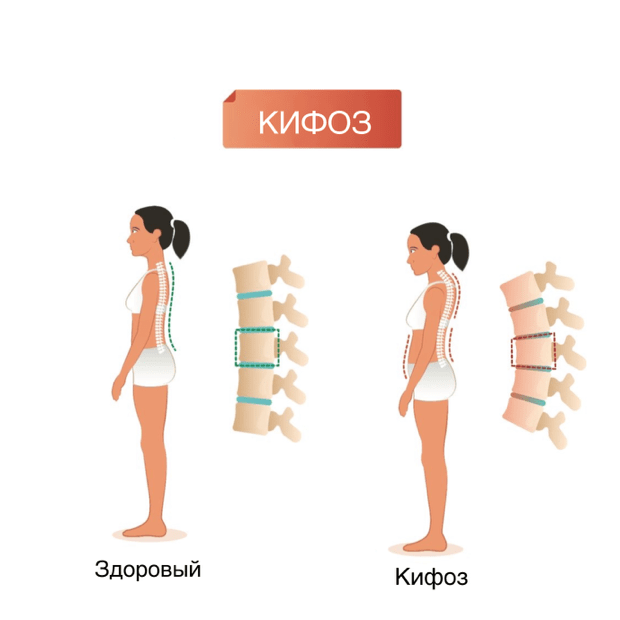 Кифоз позвоночника - картинка