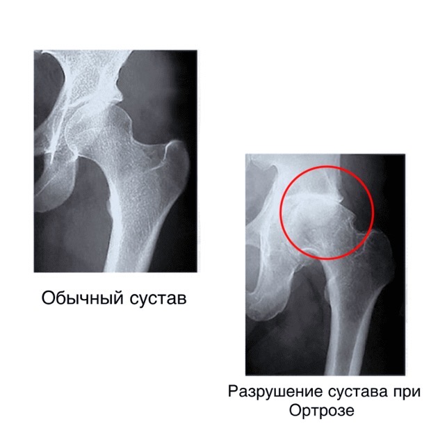 Коксартроз тазобедренного сустава - картинка