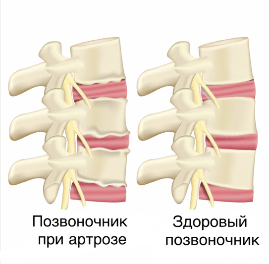 spondiloartroz