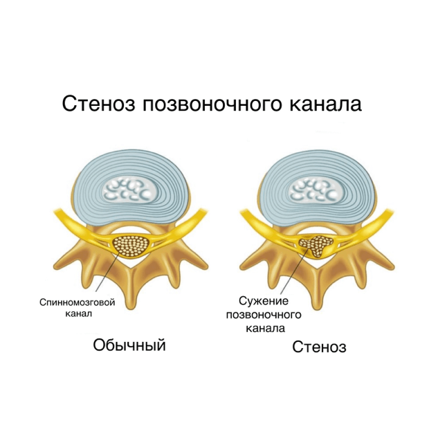 Стеноз позвоночника - картинка