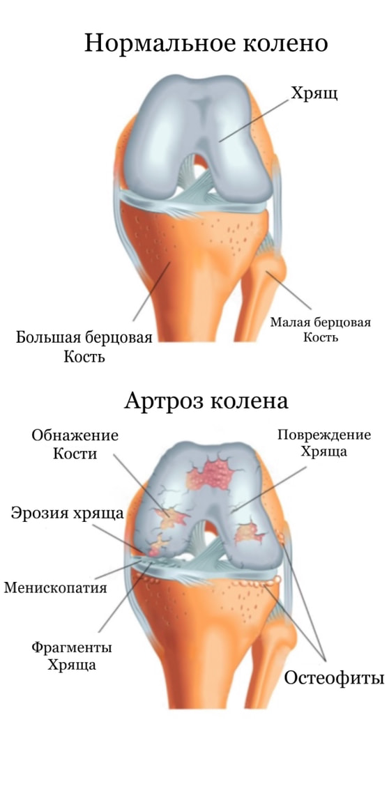Артроз колена -картинка