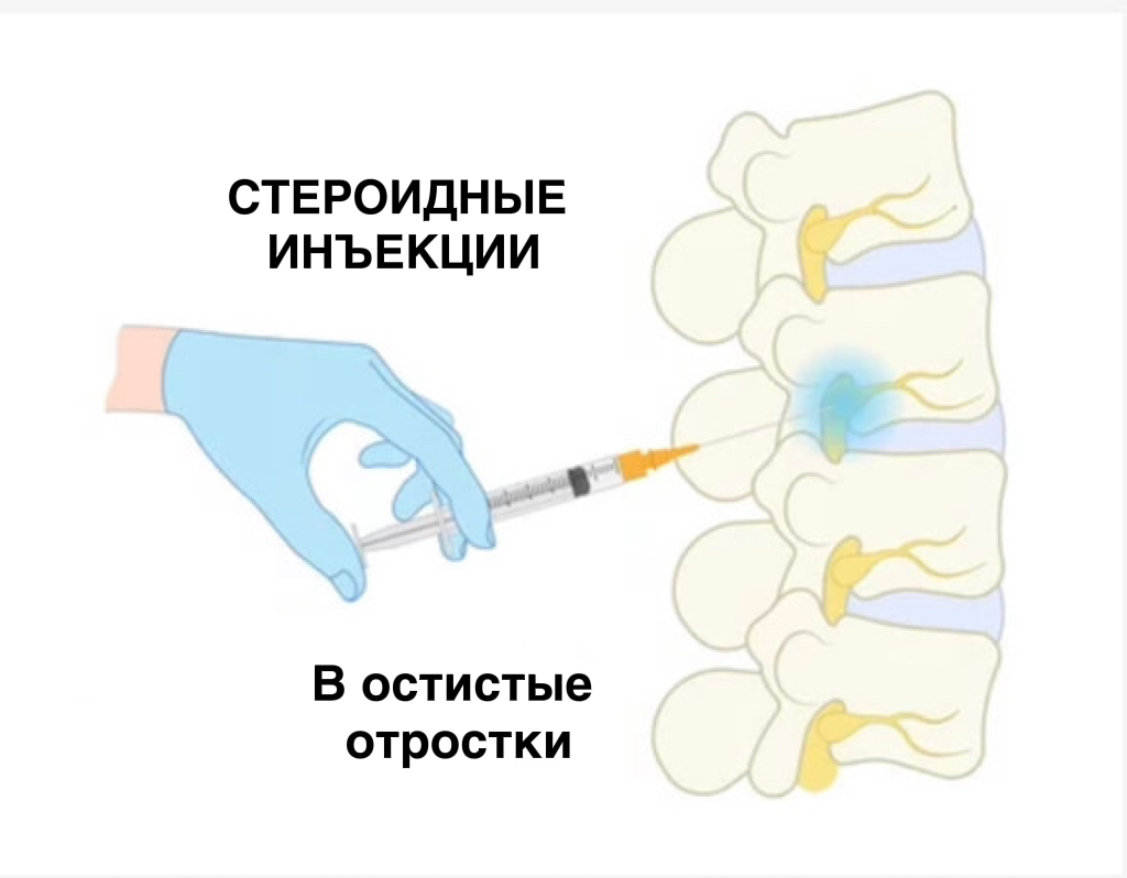 Стероидная блокада позвоночника- картинка