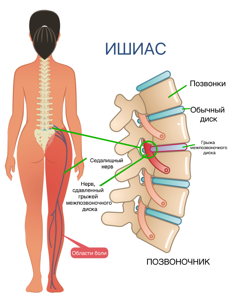 Люмбоишиалгия позвоночника-картинка