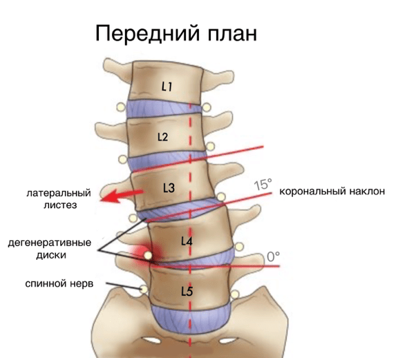 Листез, смещение позвонка в бок - картинка