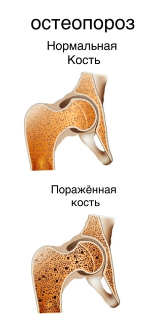 Остеопороз - картинка