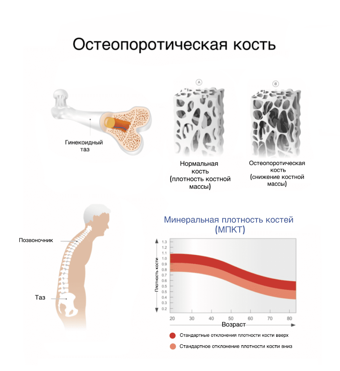 Остеопороз костей - картинка