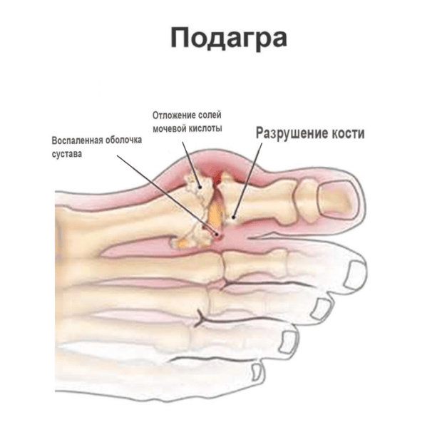 Подагра-рисунок