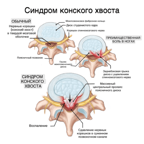 Синдром конского хвоста - картинка
