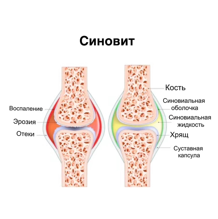 Синовит коленного сустава - диагностика и лечение