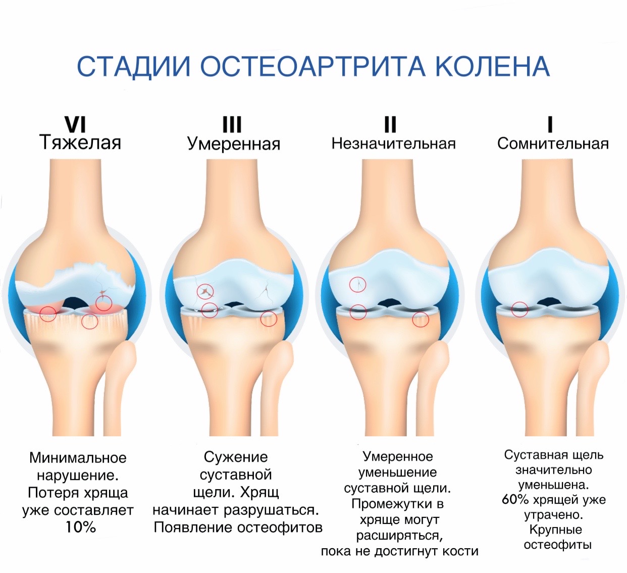 Стадии остеоартрита колена - картинка