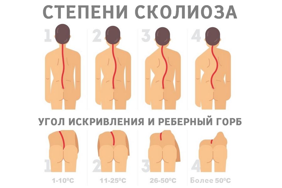 4 степени сколиоза - картинка