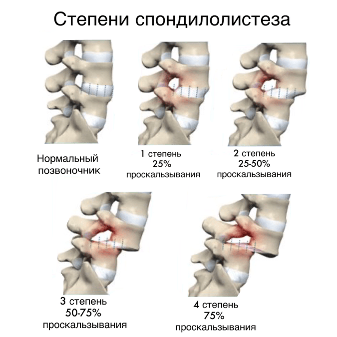 Степени листеза позвонков - картинка