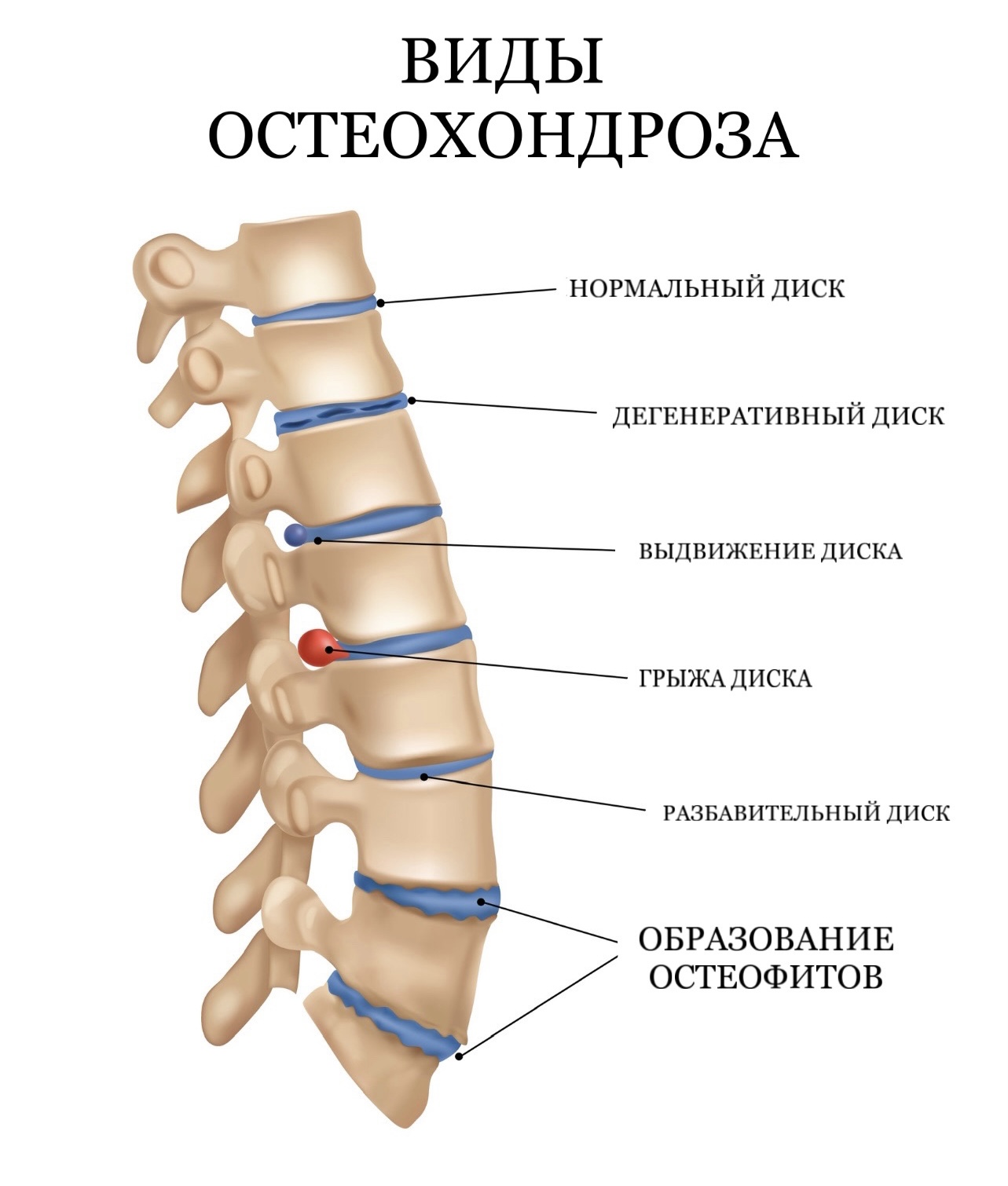 Виды остеохондроза _ картинка